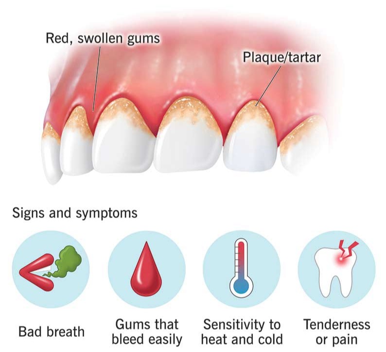 Gum Disease Gone
