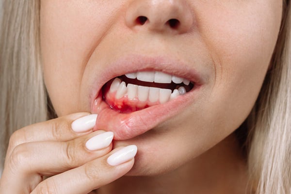 Gum Disease Gone