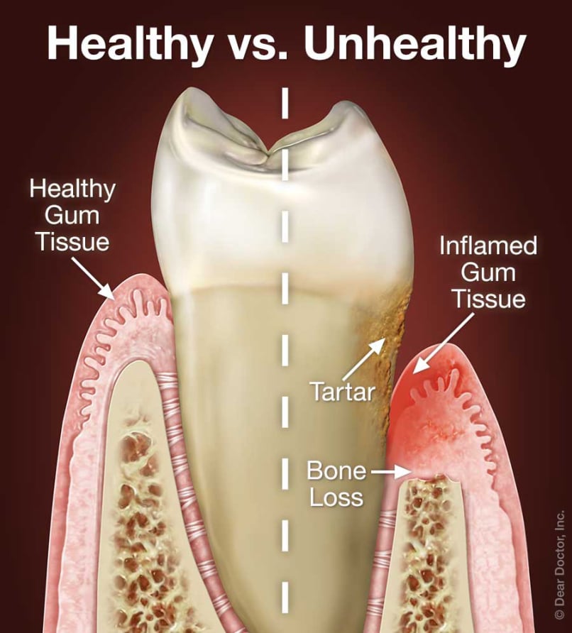 Gum Disease Gone