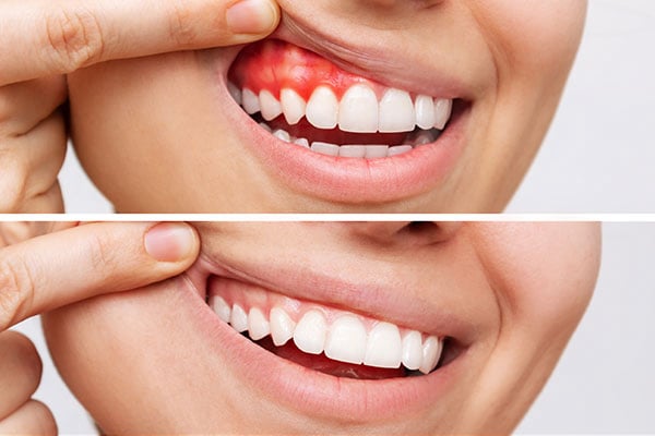 Gum Disease Gone